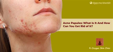 Acne Papules What Is It And How Can You Get Rid Of It