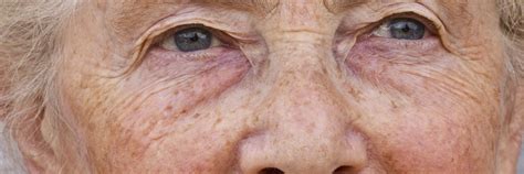 Age Spots Treatment Platinum Dermatology