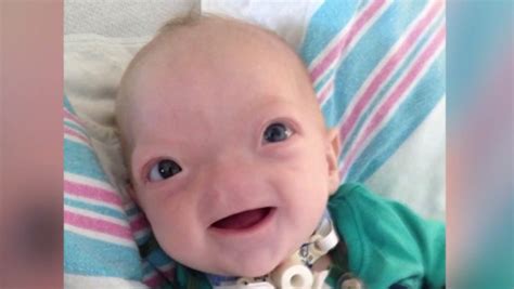 Miracle Baby Eli Born Without A Nose Dies At 2 Wpec