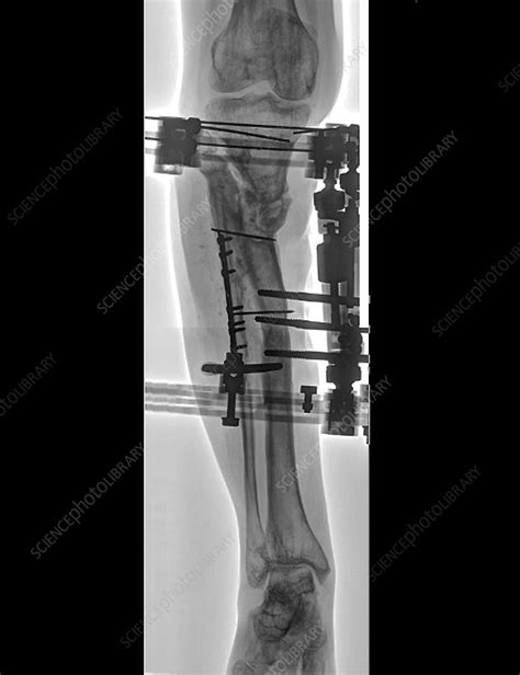 Pinned Fractured Lower Leg Bones X Ray Stock Image C0403302