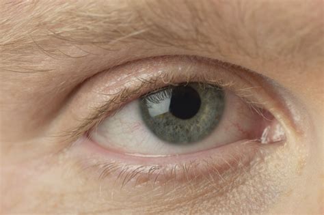 Eye Infection In Hpv Healthfully