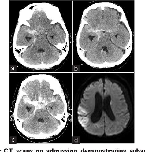 Figure 1 From Middle Cerebral Artery Dissection Causing Subarachnoid