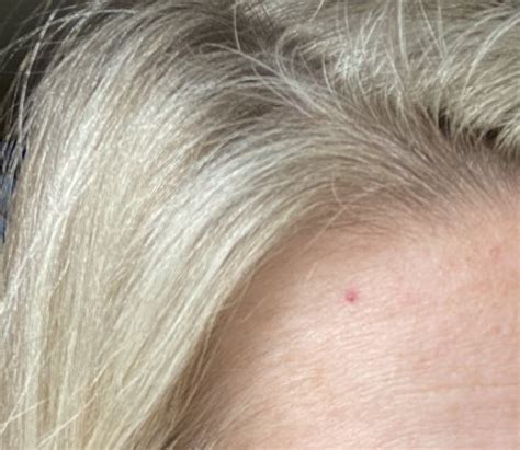Ot Red Spot On Forehead That Wont Healskin Cancer Babycenter