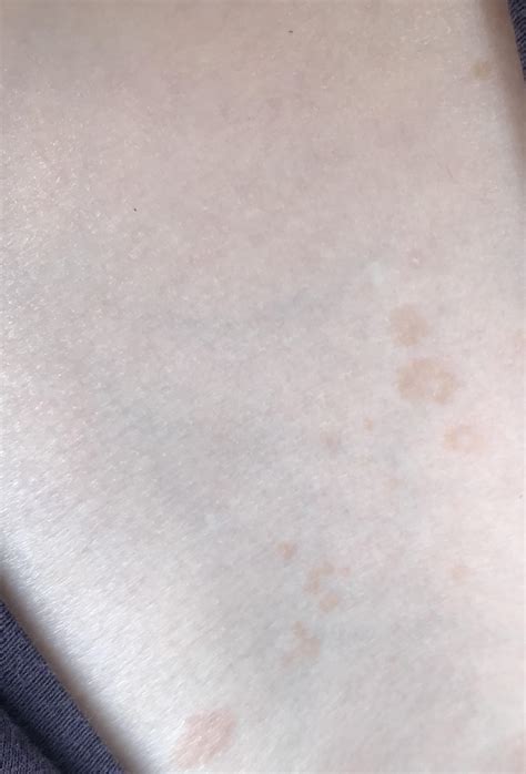 Weird Spots On Skin Rdoctorsadvice