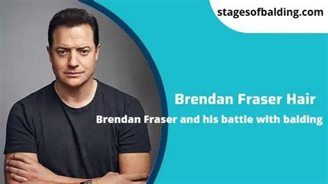 Brendan Fraser Hair And His Battle With Balding Stages Of Balding