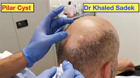 Double Pilar Cyst Removal Part Live DR Khaled Sadek Pimple