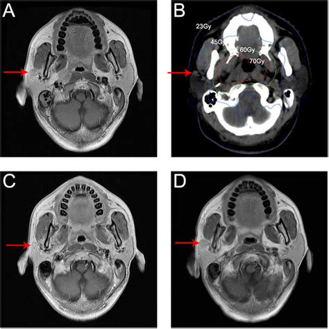 Imaging Of Parotid Lymph Node Involvement In The Right Parotid Gland In