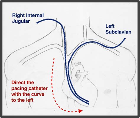 Dr Smiths Ecg Blog Emergency Transvenous Cardiac Pacing