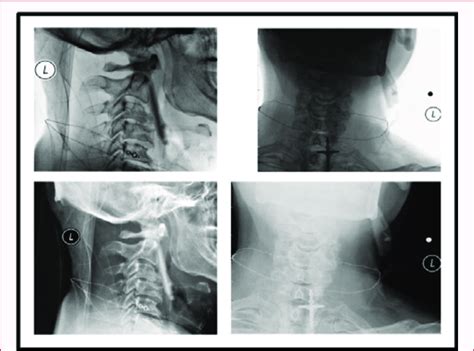 Neck X Ray Showing A Glass Foreign Body In The Left Neck Download