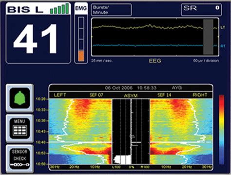 Bispectral Index Monitoring And Intraoperative Awareness Wfsa Resources