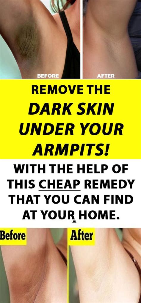 Remove Dark Skin Under Your Armpits With The Help Of This Cheap Remedy