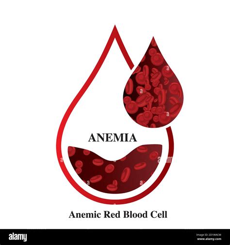 Anemia Amount Of Red Blood Iron Deficiency Anemia Difference Of Anemia