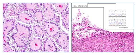 Ovarian Cancer Spore — Gynecologic Disease Laboratory