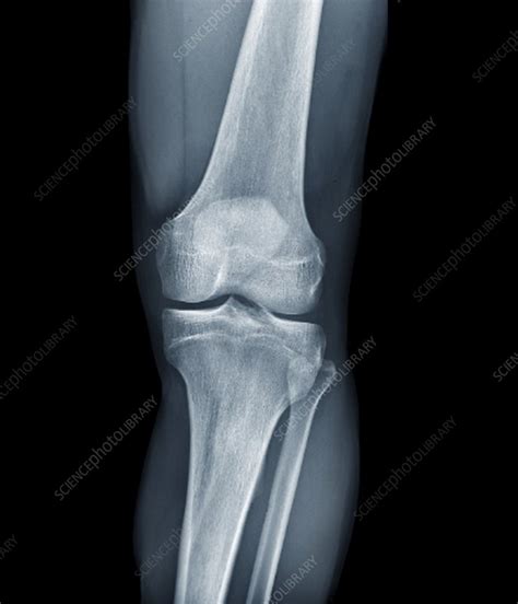 Normal Knee X Rays Stock Image F0117592 Science Photo Library