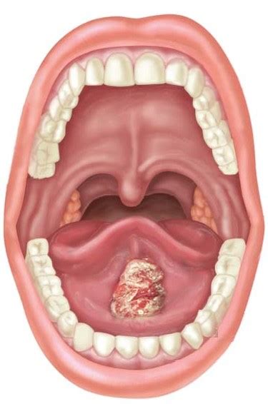 Dr Javier Calderón Polanco Tumores de Cavidad Oral