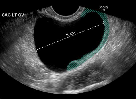 Graafian Follicle Ultrasound