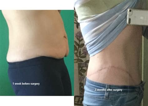 Circumferential Abdominoplasty Body Lift Final Pics MyFitnessPal Com