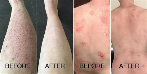 Natural Ways To Relieve Your Psoriasis Salts Of The Earth