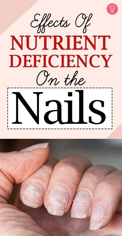 Zinc Deficiency Symptoms Nutrient Deficiency Vitamin Deficiency Iron Deficiency Nail