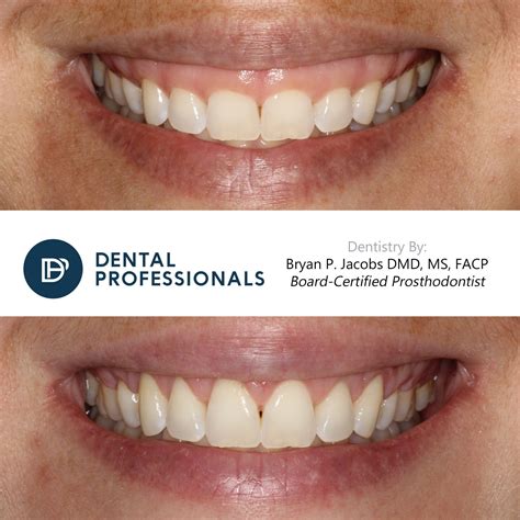 Gummy Smile Before And After Photos Chicago Dental Professionals