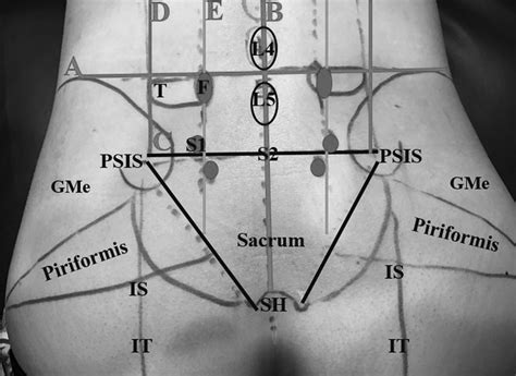 the surface anatomy of the lumbosacral area is shown a is the line download scientific diagram