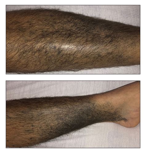 Chronic Hyperpigmented Patches On The Legs Mdedge Dermatology