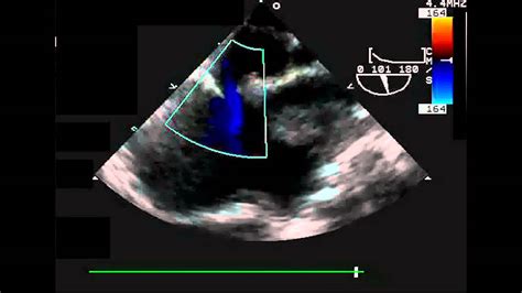 Secundum Asd Tee Bicaval View Color Doppler Youtube