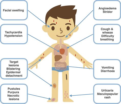 Anaphylaxis Rash Anaphylaxis An Overview Health And Medical