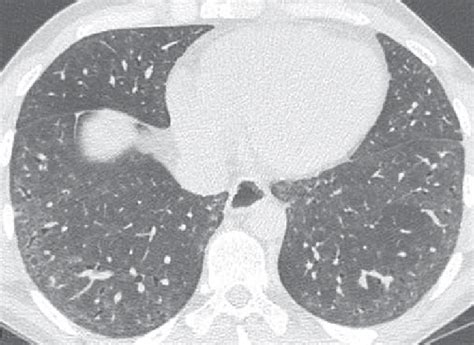 Nsip Pattern In A 33 Yo Female Patient With Pss Axial Ct Image