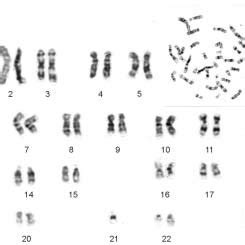 Pdf Familial Robertsonian Translocation In A Down Syndrome