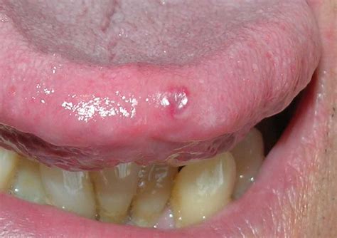 Vascular Lesion Affecting The Tip Of The Tongue Download Scientific