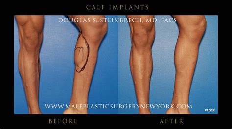 Calf Implants Surgery In Nyc