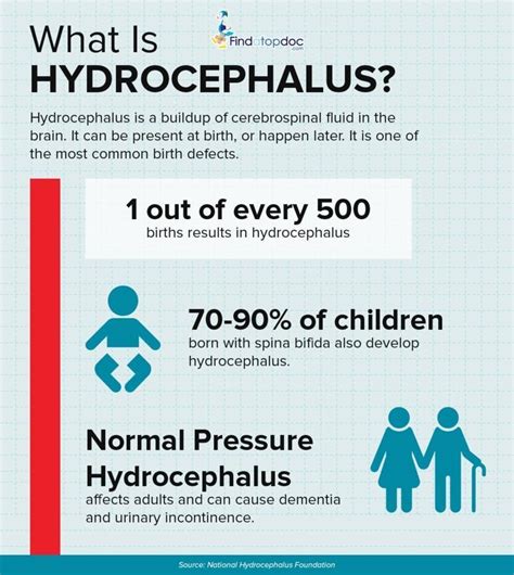 Hydrocephalus Symptoms Causes Treatment And Diagnosis Findatopdoc