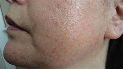 Dermatology Skin Conditions Face