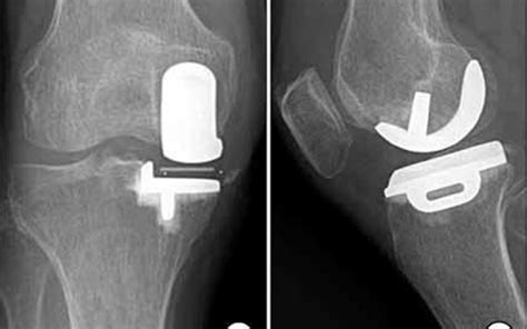 Partial Knee Replacement Dr Kapil Saoji