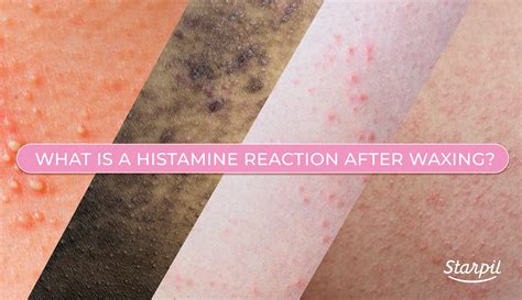 What Is A Histamine Reaction After Waxing Starpil Wax