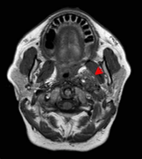 Incidentally Detected Carotid Body Tumour Case Report Sumers