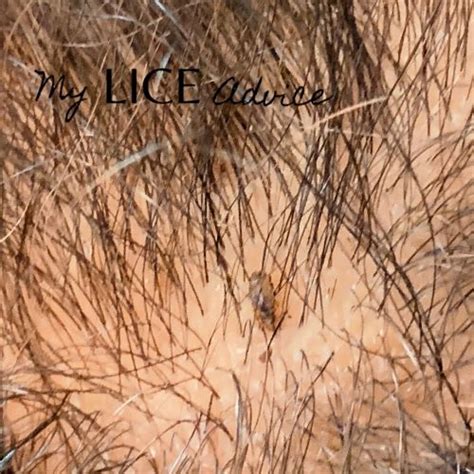 Black Lice And Lice In Black Hair With Pictures My Lice Advice
