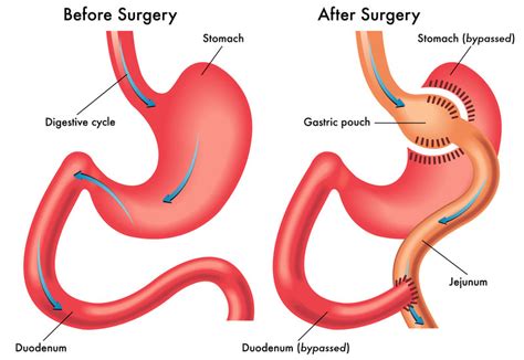 Gastric Bypass Surgery Bariatric Surgery Ucla Health