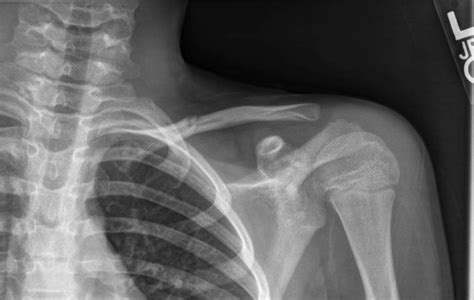 Clavicle Fractures Jared Lee Md