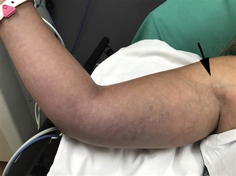 Young Woman With A Blue Painful And Swollen Arm Annals Of Emergency