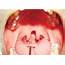 Intraoral Photograph Showing Bifid Uvula Case 1  Download Scientific