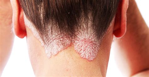 Psoriasis 6 Common Myths