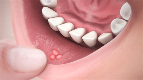 Canker Sores Causes Symptoms Treatment And Medication
