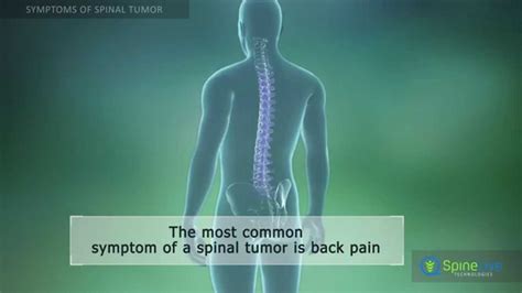 Spinal Tumor Symptoms Youtube