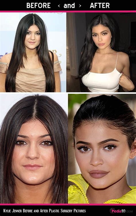 old kylie jenner lips and faces plastic surgery before and after pic 1 kylie jenner lips
