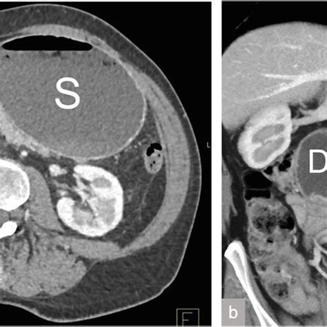 Axial Computed Tomography Image Showing Intrahepatic Duct Dilatation