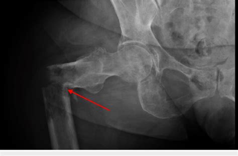 Proximal Femoral Fracture