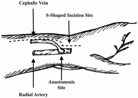S Shaped Skin Incision Demonstrating The Position Of The Incision To