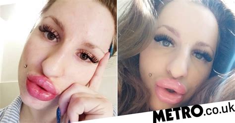 Woman Obsessed With Having Huge Lips Spends Thousands On Filler Metro